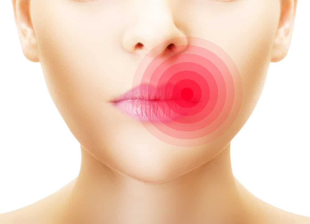 Why Do Cold Sores Appear and How Can You Prevent Them? my.DrugGenius